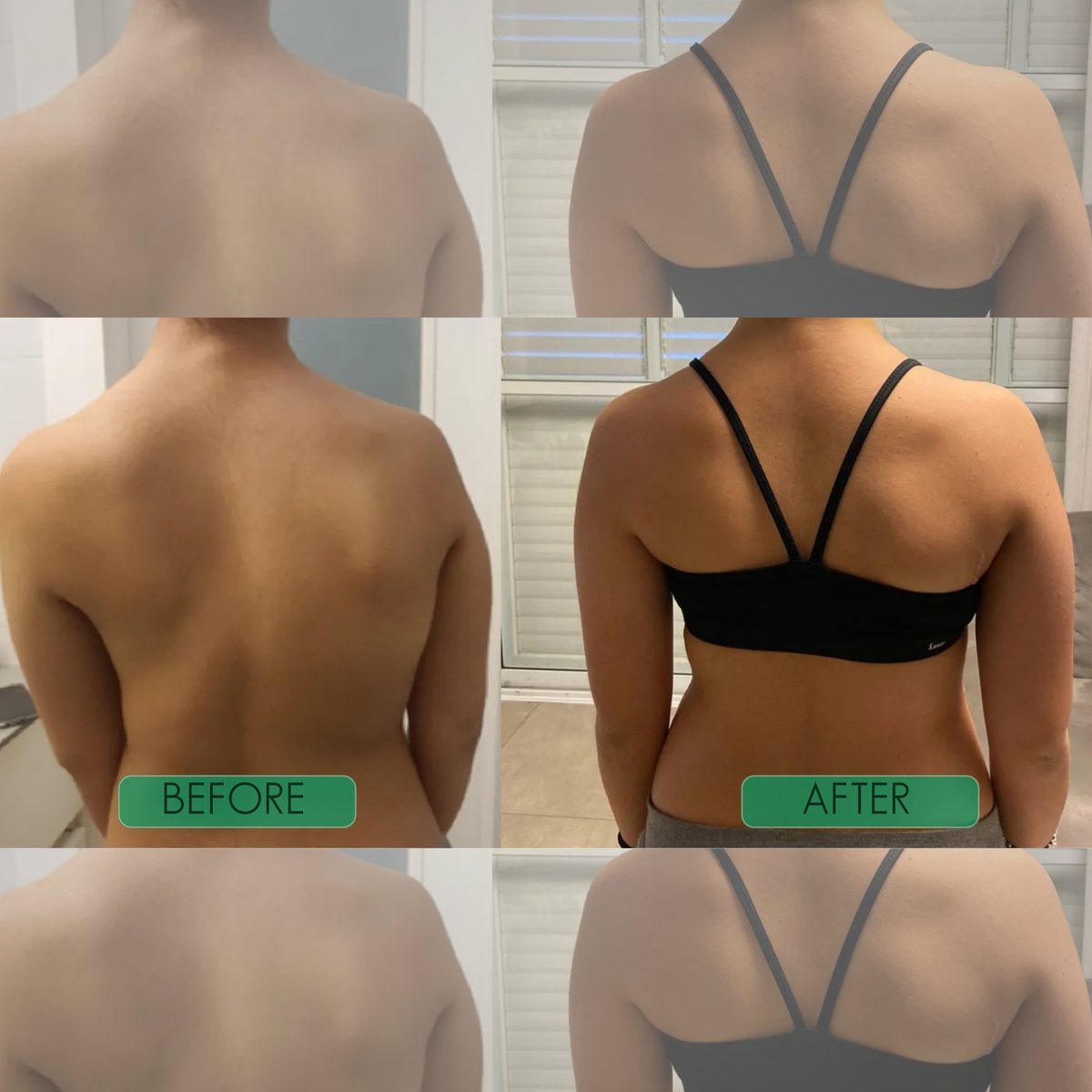 Alignwell™ Instant Posture Corrector Straps